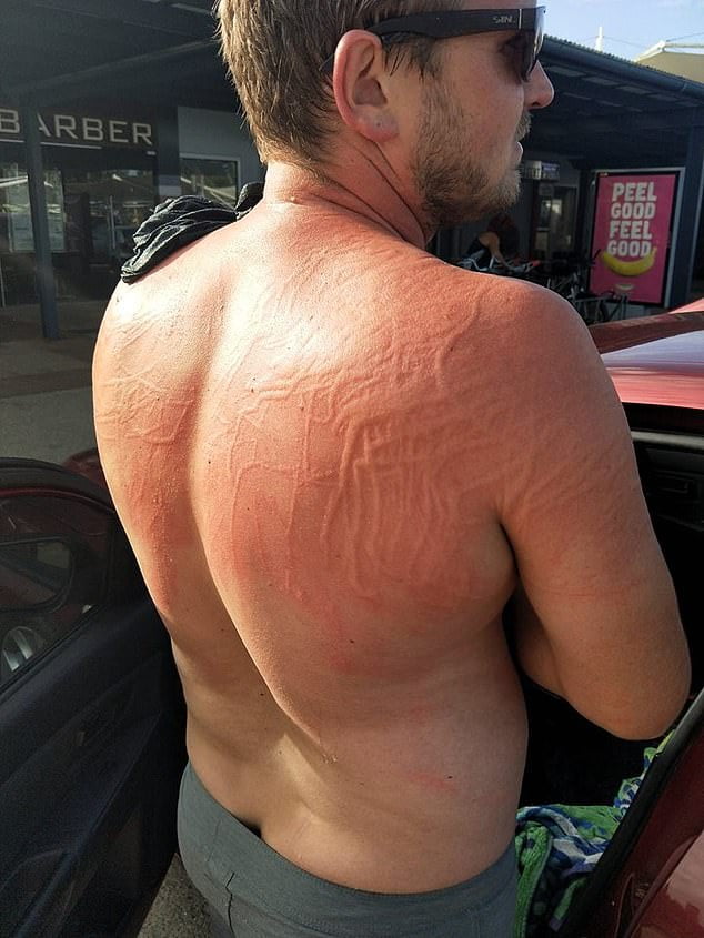 Kaj storiti, če vas opeče meduza? – Pokukaj24: Več kot le novice